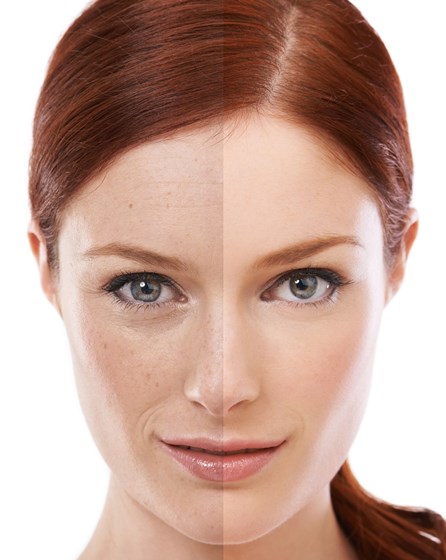 Skin Clinic Wimbledon: Lip Fillers Wimbledon